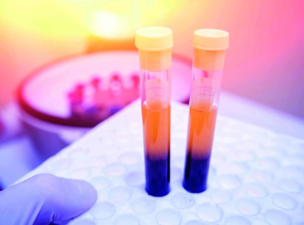 Cette centrifugation va permettre d’isoler les plaquettes puis de les prélever et d’obtenir une seringue de plaquettes (5 ml) permettant l’injection dans le site lésionnel. (Figure 2)