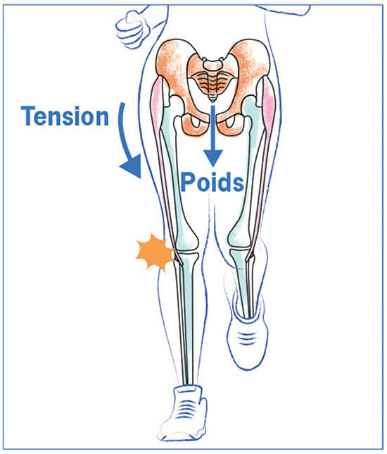 DESSIN 1: un hauban latéral tire en sens inverse de votre poids de corps et cause le syndrome de l’essuie-glace