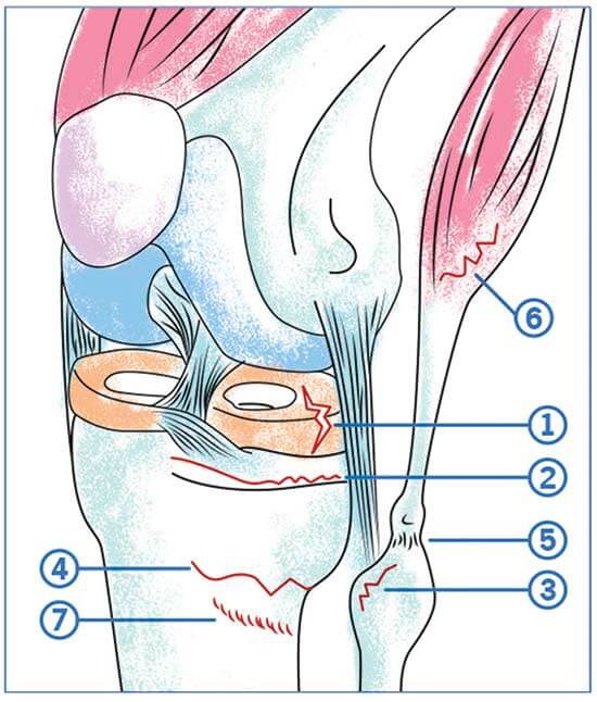 Syndrome de l'essuie-glace: la blessure du coureur – Docdusport