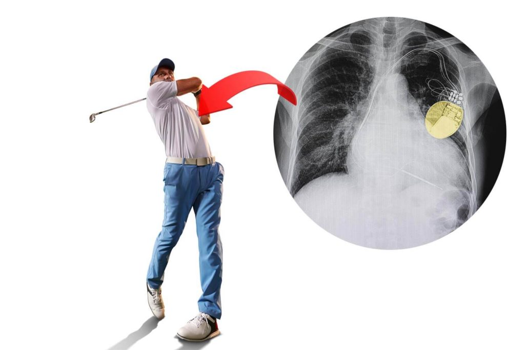 Faire du golf-avec un stimulateur cardiaque ou un défibrillateur