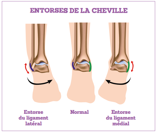 Les différentes entorses de la cheville