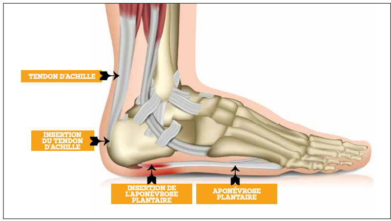 Une aponévrosite plantaire, c'est quoi?