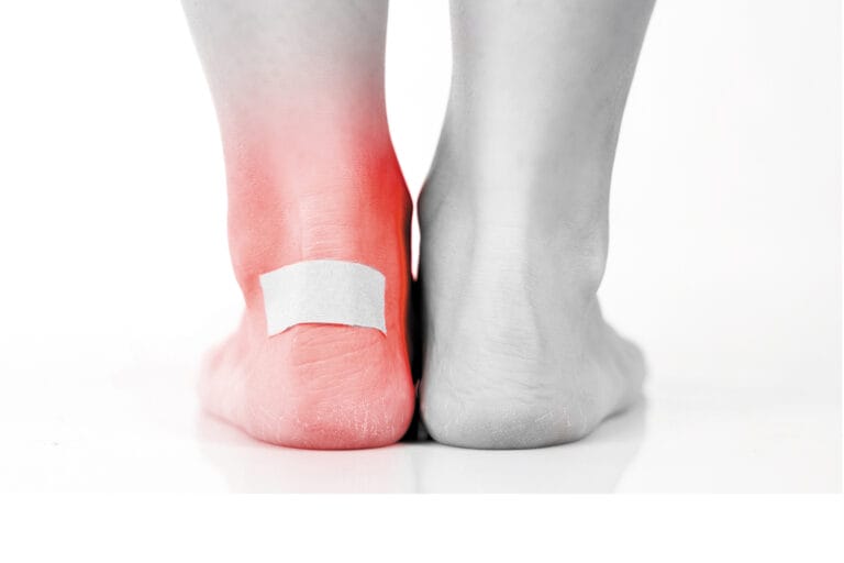 Ampoules comment les éviter ? Docdusport