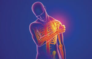 L’arthropathie acromio-claviculaire : une blessure emblématique de la muscu