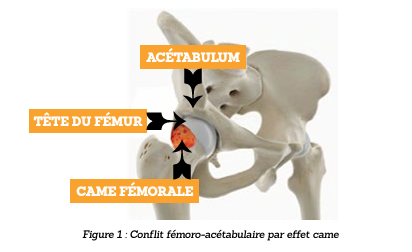 Conflit fémoro-acétabulaire par effet came