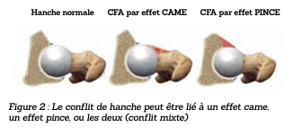 Figure 2 : Le conflit de hanche peut être lié à un effet came,  
un effet pince, ou les deux (conflit mixte)