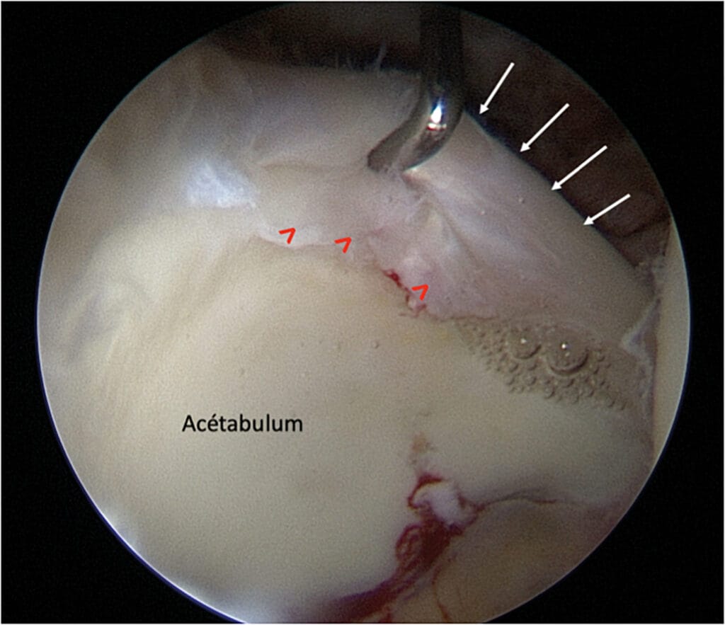 Figure 3 : Vue opératoire 
sous arthroscopie montrant une lésion du labrum (flèches blanches : labrum, flèches rouges : lésion)