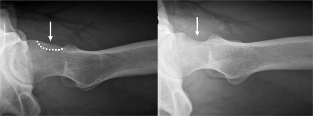  Figure 4 : Correction d’un conflit de type came  sur la radiographie de hanche